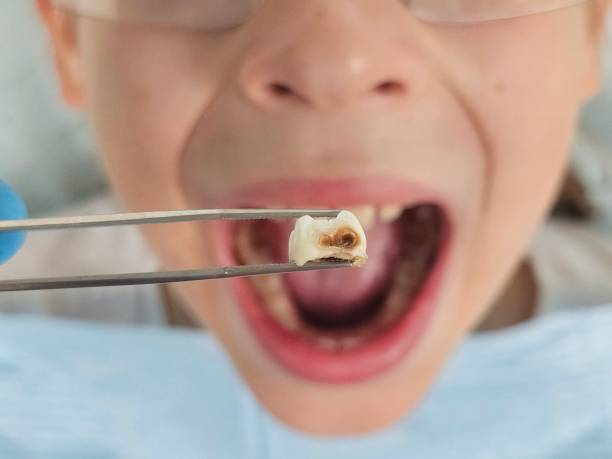 Best Knocked-Out Tooth (Avulsed Tooth) Treatment in Crewe, VA